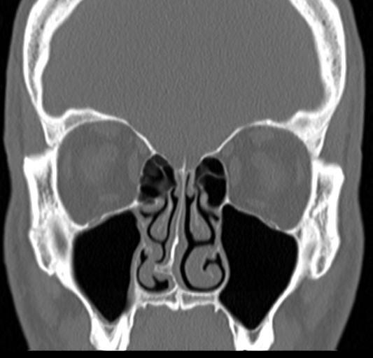 Angular epidermoid cyst (Radiopaedia 46908-51439 Coronal bone window 29).png
