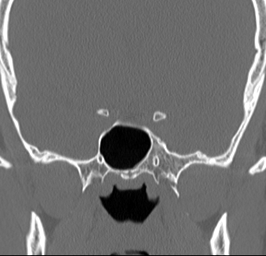 Angular epidermoid cyst (Radiopaedia 46908-51439 Coronal bone window 47).png
