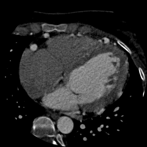 File:Anomalous left coronary artery from the pulmonary artery (ALCAPA) (Radiopaedia 40884-43586 A 51).jpg