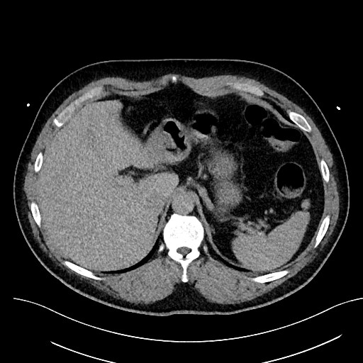 File:Anomalous origin of the left coronary artery with malignant course (Radiopaedia 77842-90126 Axial non-contrast 33).jpeg