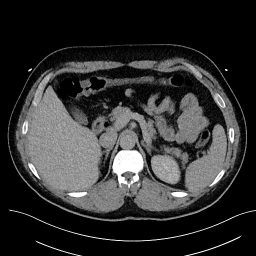 File:Anomalous origin of the left coronary artery with malignant course (Radiopaedia 77842-90126 Axial non-contrast 37).jpeg