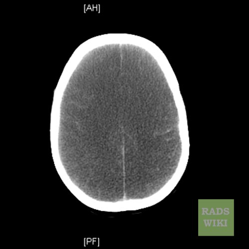 File:Anoxic brain injury (Radiopaedia 11191-11556 D 1).jpg