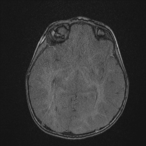 File:Anoxic brain injury (Radiopaedia 79165-92139 Axial MRA 111).jpg