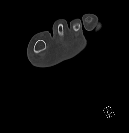 Anterior calcaneal process fracture (Radiopaedia 63353-71943 Axial bone window 32).jpg