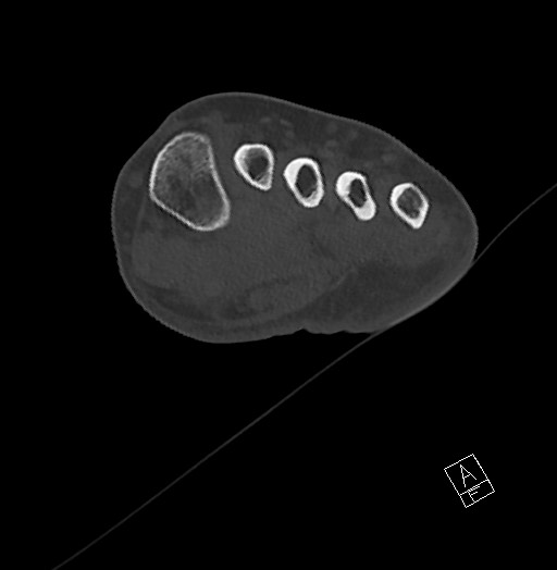 File:Anterior calcaneal process fracture (Radiopaedia 63353-71943 Axial bone window 63).jpg