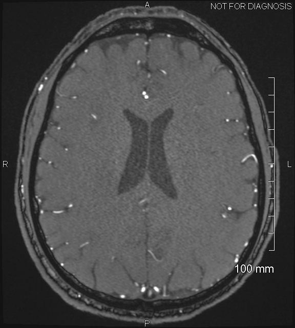Anterior cerebral artery aneurysm (Radiopaedia 80683-94127 Axial MRA 158).jpg