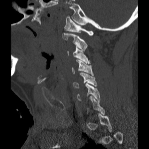 Anterior cervical postdiscectomy arthrodesis (Radiopaedia 32678-33646 Sagittal bone window 21).jpg
