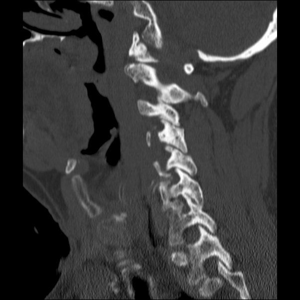 Anterior cervical postdiscectomy arthrodesis (Radiopaedia 32678-33646 Sagittal bone window 25).jpg