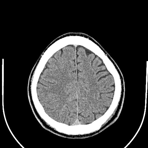 Anterior choroidal artery infarct (Radiopaedia 55106-61480 Axial non-contrast 46).jpg