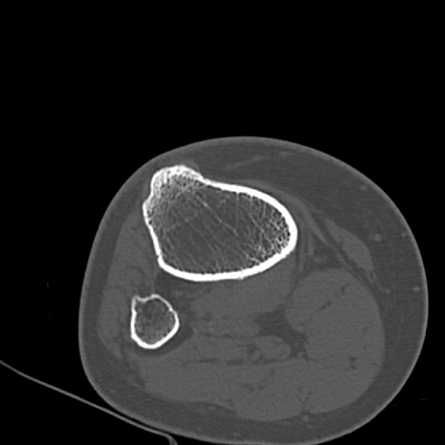 File:Anterior cruciate ligament avulsion fracture (Radiopaedia 58939-66194 Axial bone window 34).jpg