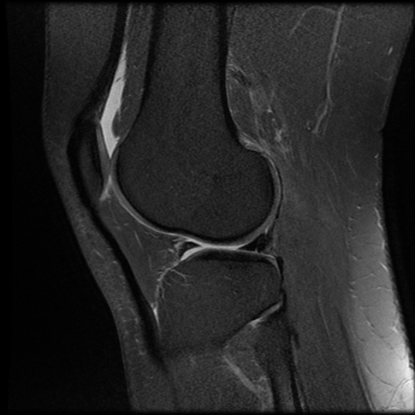File:Anterior cruciate ligament tear, Wrisberg rip and bucket-handle tear of medial meniscus (Radiopaedia 75872-87266 Sagittal PD fat sat 8).jpg