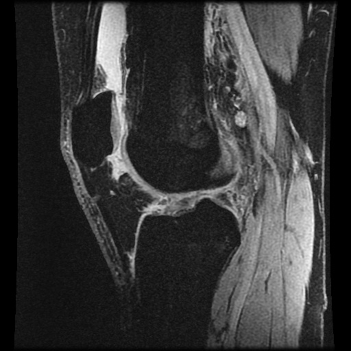 File:Anterior cruciate ligament tear (Radiopaedia 61500-69462 F 50).jpg