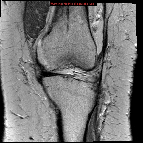 File:Anterior cruciate ligament tear - complete (Radiopaedia 12175-12514 C 5).jpg
