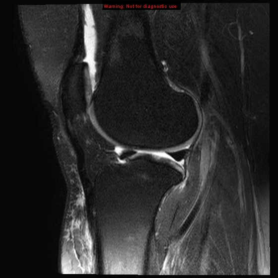 File:Anterior cruciate ligament tear - complete (Radiopaedia 12175-12514 Sagittal T2 fat sat 8).jpg