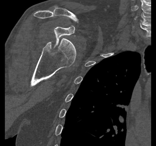 Anterior glenohumeral dislocation with Hill-Sachs lesion (Radiopaedia 62877-71249 Coronal bone window 40).jpg