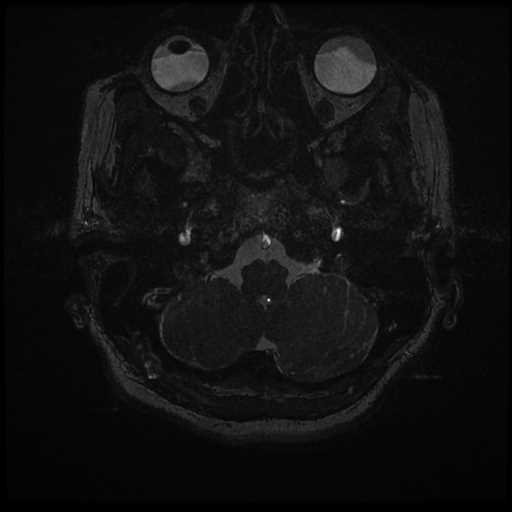 Anterior inferior cerebellar artery vascular loop - type II (Radiopaedia 70991-81209 Axial 3D FIESTA 71).jpg
