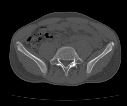Anterior inferior iliac spine avulsion fracture (Radiopaedia 81312-94999 Axial bone window 19).jpg
