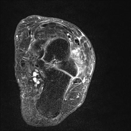 File:Anterior talofibular ligament injury - rupture with soft-tissue impingement (Radiopaedia 38765-40928 D 22).jpg