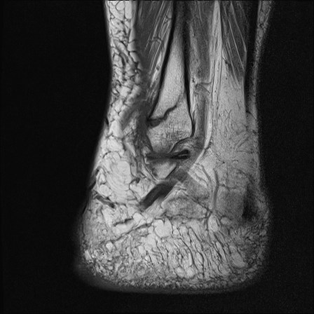 File:Anterior talofibular ligament injury - rupture with soft-tissue impingement (Radiopaedia 38765-40928 Sagittal PD 17).jpg