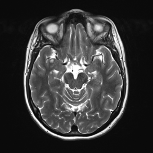 File:Anterior temporal lobe perivascular space (Radiopaedia 40946-43650 Axial T2 15).png