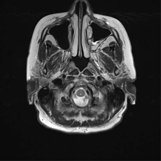File:Anterior temporal pole cysts (Radiopaedia 46629-51102 C 4).png