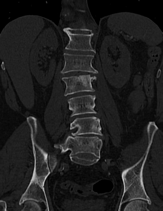 Anterior vertebral scalloping (abdominal aortic aneurysm) (Radiopaedia 66744-76067 Coronal bone window 39).jpg