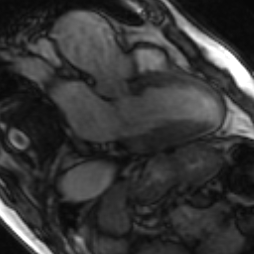 File:Anteroseptal hypokinesia after myocardial infarction (Radiopaedia 15978-15633 3 chamber view SSFE 5).jpg