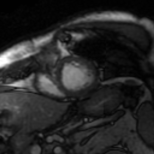 File:Anteroseptal hypokinesia after myocardial infarction (Radiopaedia 15978-15633 Short axis SSFE 25).jpg
