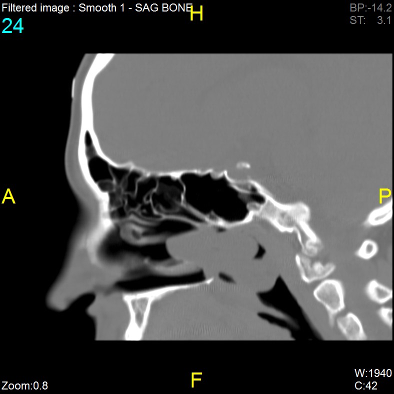 Antrochoanal polyp (Radiopaedia 65101-74094 Sagittal bone window 24).jpg