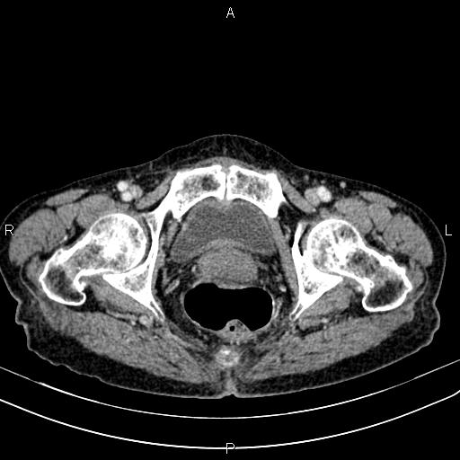 File:Aortic aneurysm and Lemmel syndrome (Radiopaedia 86499-102554 A 78).jpg