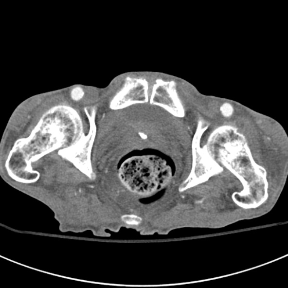 File:Aortic aneurysm with spinal destruction (Radiopaedia 42301-45410 A 112).jpg