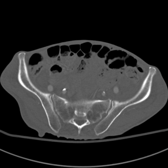 Aortic aneurysm with spinal destruction (Radiopaedia 42301-45410 Axial bone window 83).jpg