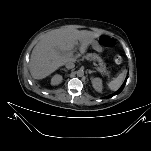 Aortic arch aneurysm (Radiopaedia 84109-99365 Axial non-contrast 288).jpg