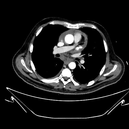 Aortic arch aneurysm (Radiopaedia 84109-99365 C 209).jpg