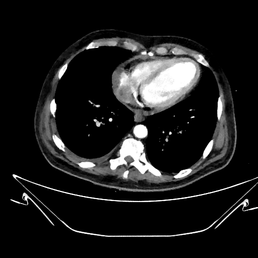 Aortic arch aneurysm (Radiopaedia 84109-99365 C 333).jpg