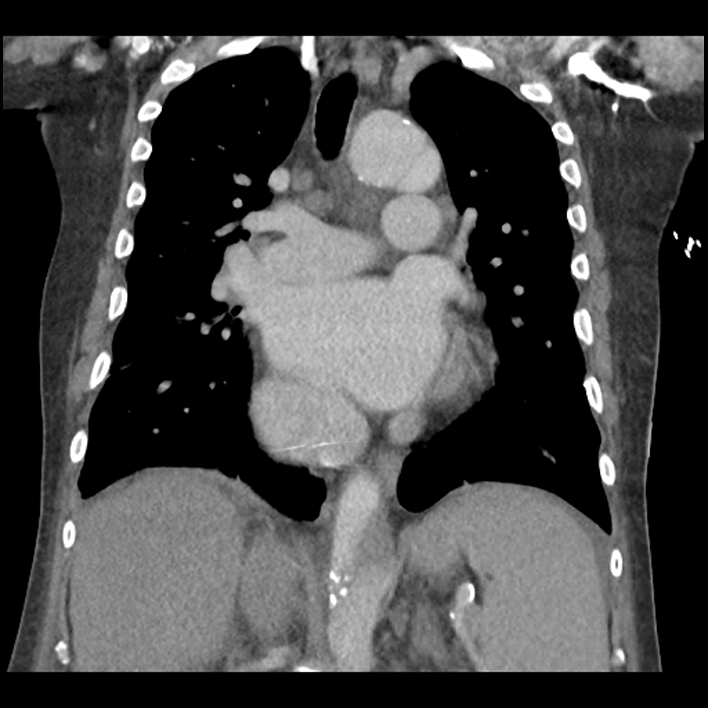 Aortic arch graft infection (FDG PET-CT) (Radiopaedia 71975-82437 Coronal 34).jpg