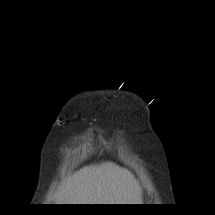 Aortic arch graft infection (FDG PET-CT) (Radiopaedia 71975-82437 Coronal 5).jpg