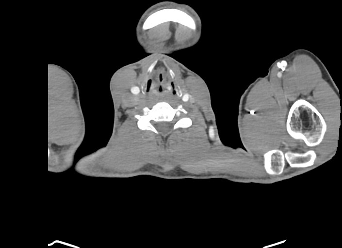 File:Aortic coarctation with aneurysm (Radiopaedia 74818-85828 A 203).jpg