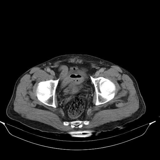 File:Aortic dissection- Stanford type A (Radiopaedia 22085-22085 Axial C+ delayed 49).jpg