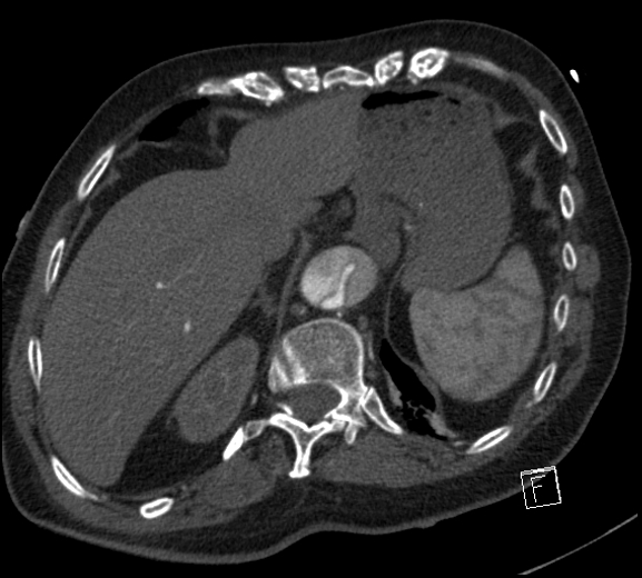 Aortic dissection (CTPA) (Radiopaedia 75506-86750 A 81).jpg