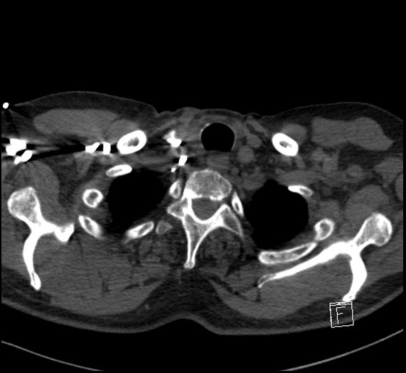 Aortic dissection (CTPA) (Radiopaedia 75506-86751 Axial C+ CTPA 11).jpg