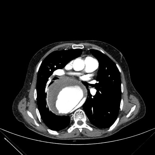 Aortic dissection (Radiopaedia 27466-27665 C+ arterial phase 125).jpg