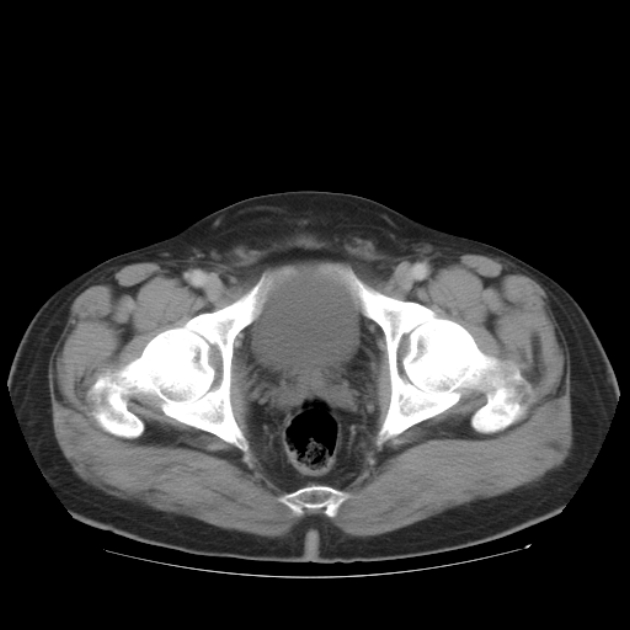 Aortic dissection (Radiopaedia 44411-48061 C 102).jpg