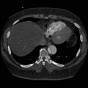 File:Aortic dissection (Radiopaedia 57969-64959 A 232).jpg
