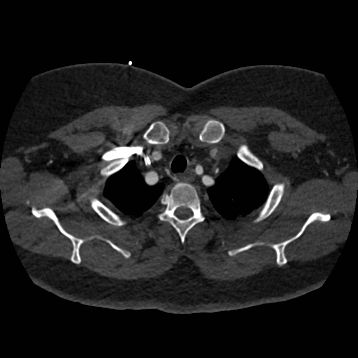 Aortic dissection (Radiopaedia 57969-64959 A 51).jpg