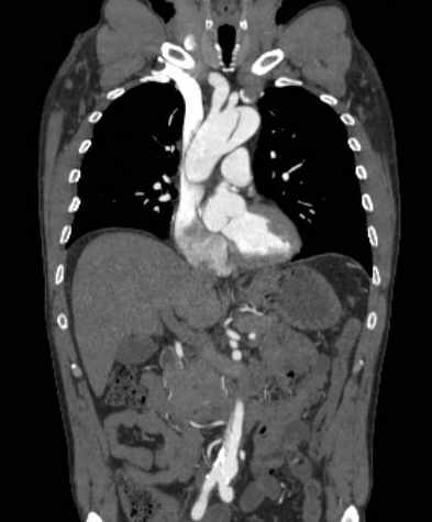 File:Aortic dissection - Stanford type B (Radiopaedia 73648-84437 B 50).jpg