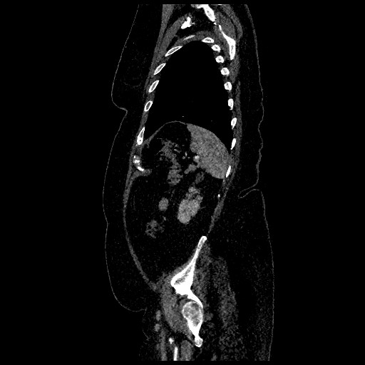 Aortic dissection - Stanford type B (Radiopaedia 88281-104910 C 73).jpg