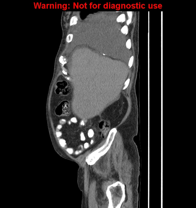 Aortic graft infection (Radiopaedia 44979-48907 C 58).jpg