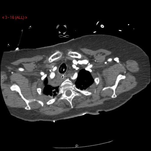 Aortic intramural hematoma (Radiopaedia 27746-28001 A 16).jpg