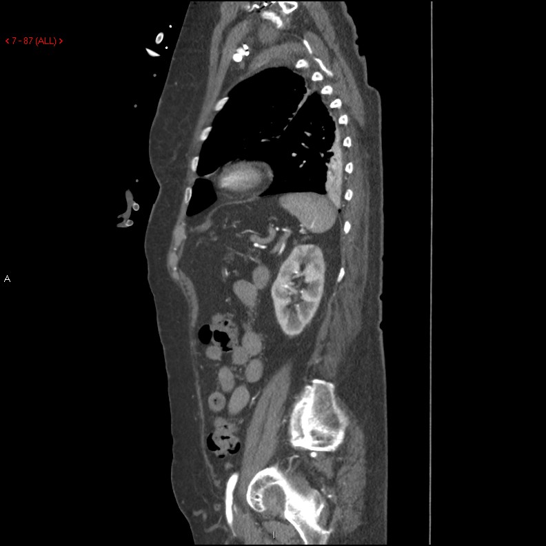 Aortic intramural hematoma (Radiopaedia 27746-28001 C 56).jpg